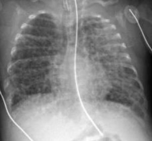 Preemie lungs with chronic lung disease.